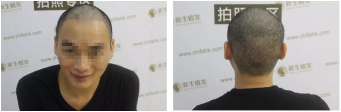 【植发案例】M型脱发额角种植1500单位