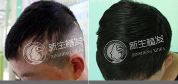 疤痕性脱发如何全面治愈