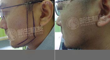 <a href=http://www.chinamaofa.com/binjiaozz/ target=_blank class=infotextkey>鬓角种植</a>2.jpg