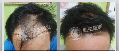 新生植发真实植<a href=http://www.chinamaofa.com/fajixianzz/ target=_blank class=infotextkey>发际线</a>案例效果图