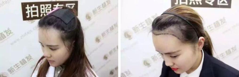 <a href=http://www.chinamaofa.com/fajixianzz/ target=_blank class=infotextkey>发际线</a>调整前后.jpg