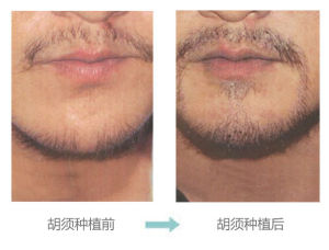 天生胡须稀少怎么治疗