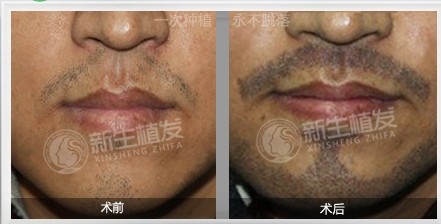 胡须不够密咋整