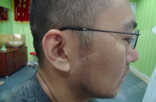 <a href=http://www.chinamaofa.com/huxuzz/ target=_blank class=infotextkey>胡须种植</a>手术是如何做的