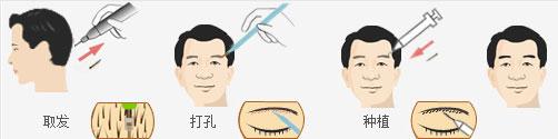眉毛缺失怎么办?