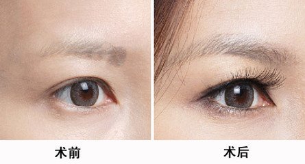 <a href=http://www.chinamaofa.com/meimaozz/ target=_blank class=infotextkey>眉毛种植</a>.jpg