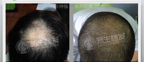 杭州<a href=http://www.chinamaofa.com/meirenjianzz/ target=_blank class=infotextkey>美人尖</a>种植多少钱