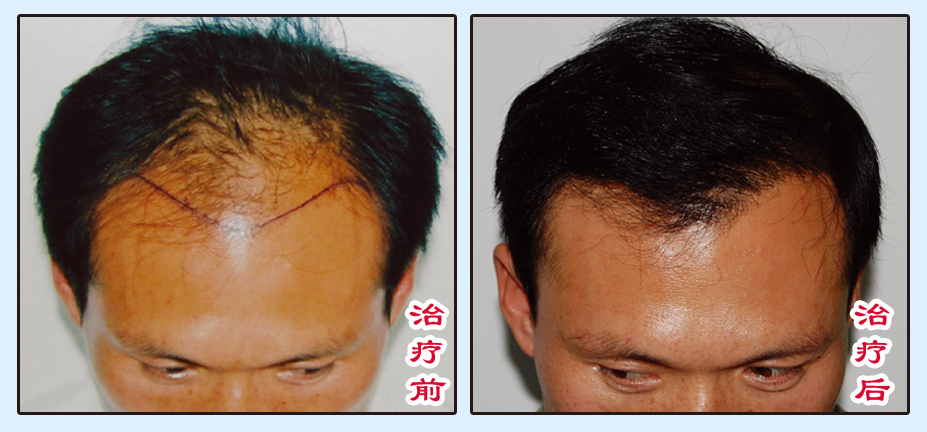 杭州<a href=http://www.chinamaofa.com/meirenjianzz/ target=_blank class=infotextkey>美人尖</a>