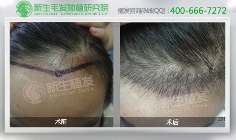 <a href=http://www.chinamaofa.com/meirenjianzz/ target=_blank class=infotextkey>美人尖</a>种植效果图
