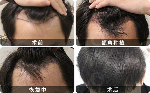 新生植发<a href=http://www.chinamaofa.com/zhifaanli/ target=_blank class=infotextkey>植发效果</a>案例图