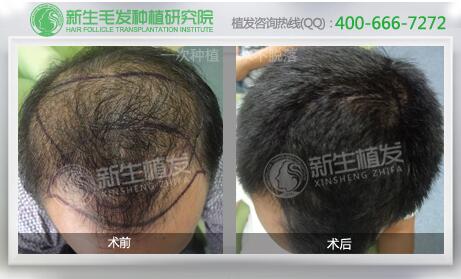 新生<a href=http://www.chinamaofa.com/zfal/ target=_blank class=infotextkey>植发案例</a>.jpg