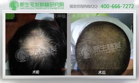 <a href=http://www.chinamaofa.com/zfal/ target=_blank class=infotextkey>植发案例</a>.jpg