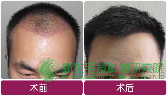 <a href=http://www.chinamaofa.com/zhifaanli/ target=_blank class=infotextkey>植发效果</a>图jpg.jpg