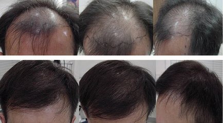头发加密效果明显吗