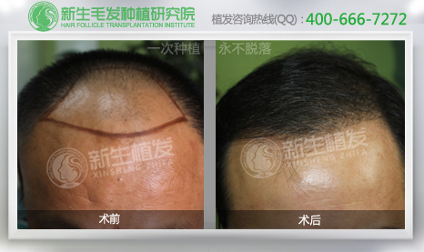 杭州做植发哪家比较好
