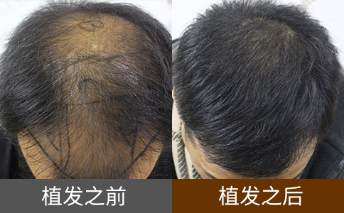 植发上只能用后脑勺的毛发吗
