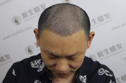 植发术后10天