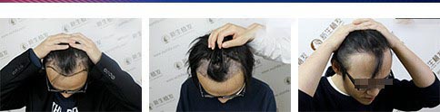 <a href=http://www.chinamaofa.com/toufazz/ target=_blank class=infotextkey>头发种植</a>恢复需多长时间?<a href=http://www.chinamaofa.com/zhifaanli/ target=_blank class=infotextkey>植发效果</a>能保持多久?