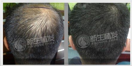 新生植发真实<a href=http://www.chinamaofa.com/zfal/ target=_blank class=infotextkey>植发案例</a>效果图