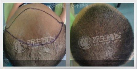 植发后头发还会脱落吗