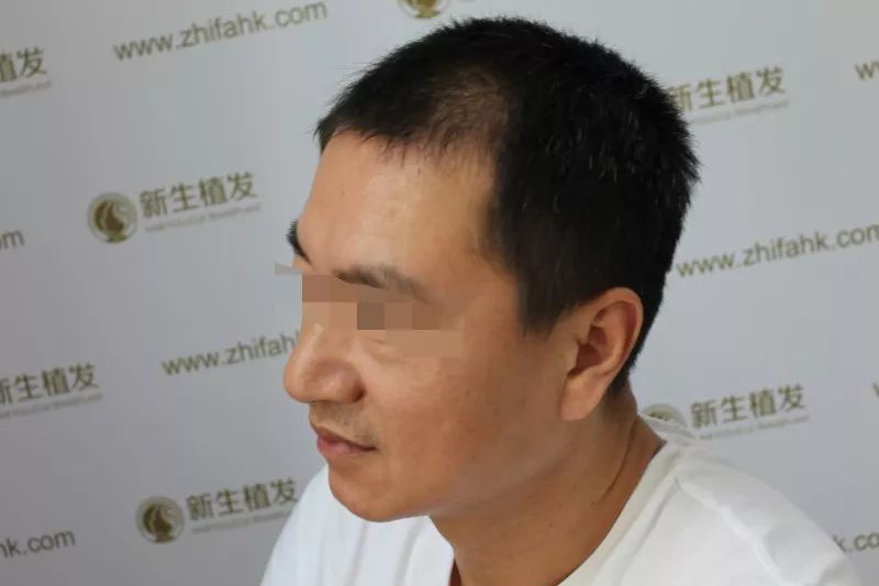 新生植发SIMSON案例