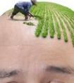 脂溢性脱发有哪些特点?有什么治疗方法?