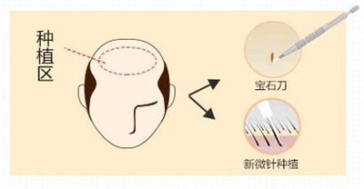 微针<a href=http://www.chinamaofa.com/zhifaanli/ target=_blank class=infotextkey>植发效果</a>好吗