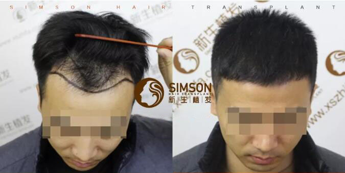 女性脱发该怎么办?