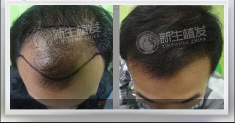 植发多久后可以洗头发