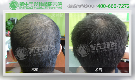 新生<a href=http://www.chinamaofa.com/zhifaanli/ target=_blank class=infotextkey>植发效果</a>图2.jpg