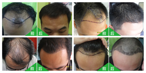 新生种植头发效果怎么样