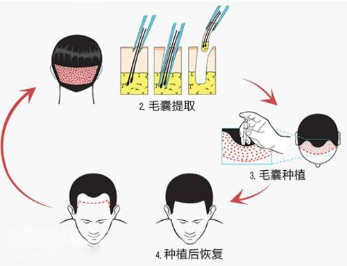 头发种植后可以维持多久_新生植发医院