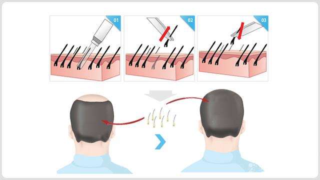 去除干性头皮的8种佳方法——新生植发