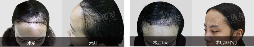 去武汉植发靠谱吗